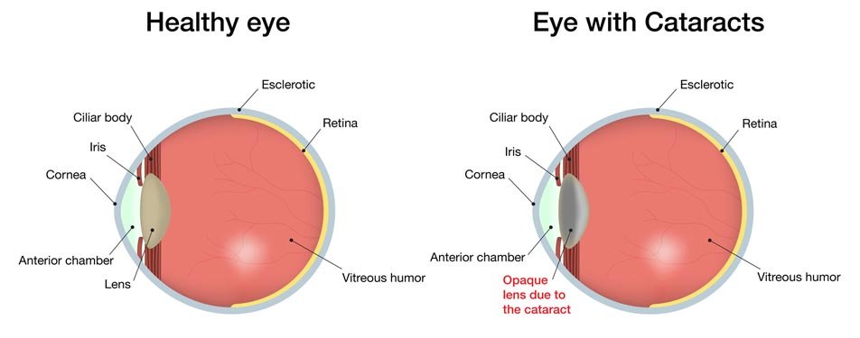 Blade Free Cataract Surgery