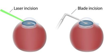 Blade Free Cataract Surgery