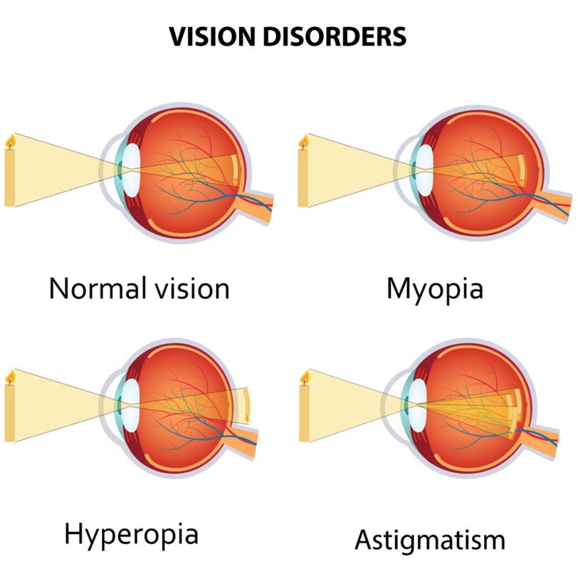 Vision Disorders