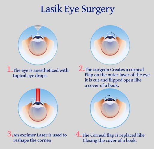 Lasik Eye Surgery