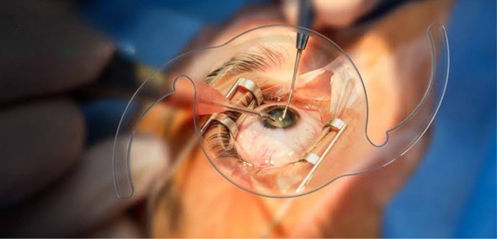 Cataract-Eye-Surgery