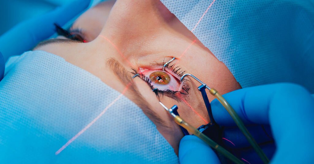 Lasik-Surgery