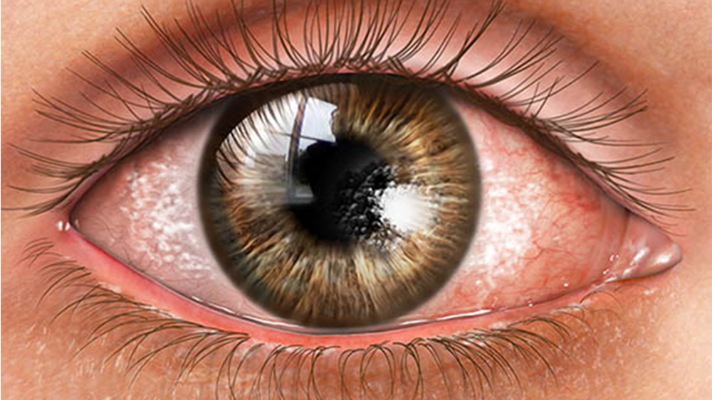 Pediatric-Eye-CareN