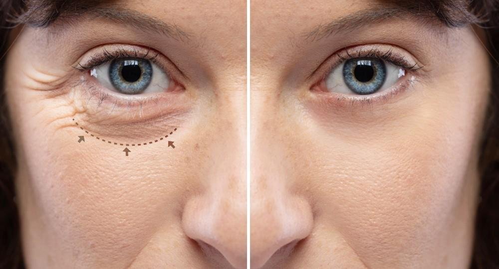 oculoplastic